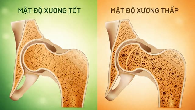 Mật độ xương bao nhiêu là tốt? Làm thế nào để duy trì?