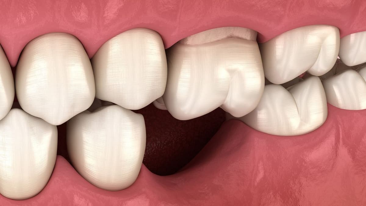 Mất răng lâu năm có trồng được không?