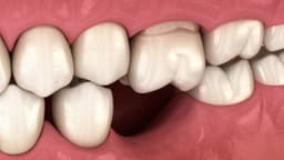 Mất răng lâu năm có trồng được không?