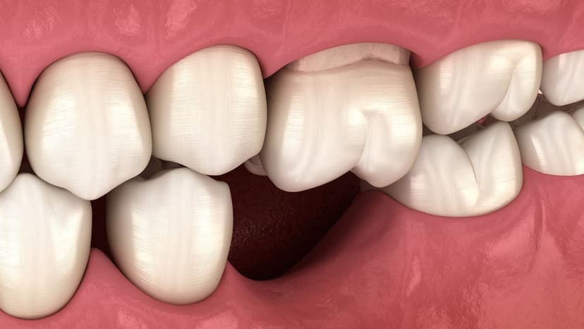 Mất răng lâu năm có trồng được không?