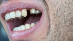 Mất răng số 4 có sao không? Có thể niềng không?