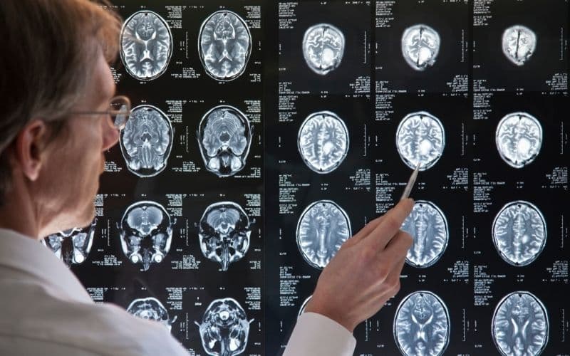 mổ u não lành tính sống được bao lâu