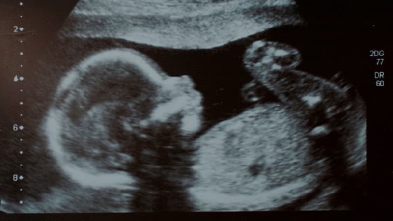 nếp gấp da gáy theo tuổi thai