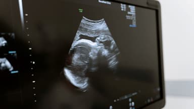 Đo nếp gấp da gáy theo tuổi thai