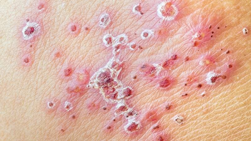 bị zona ngứa phải làm sao