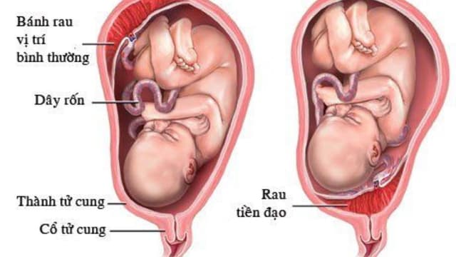 Nguyên nhân bánh nhau dày trong thai kỳ