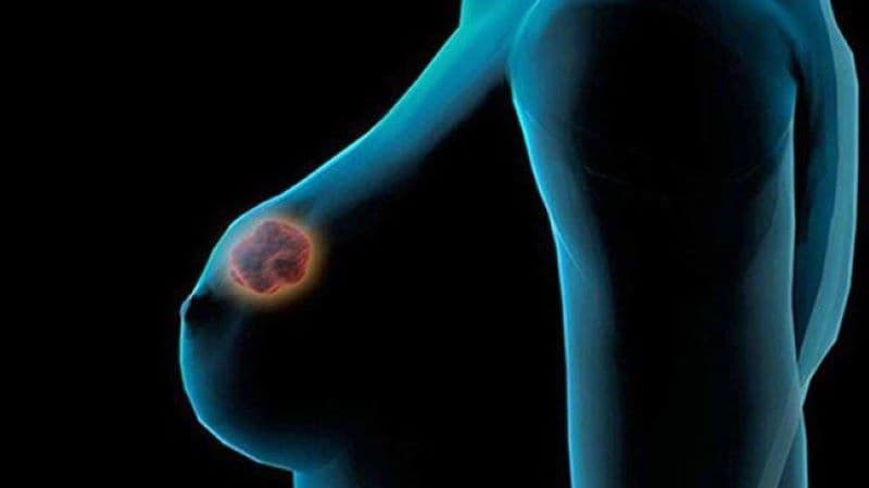 áp xe vú ở tuổi dậy thì