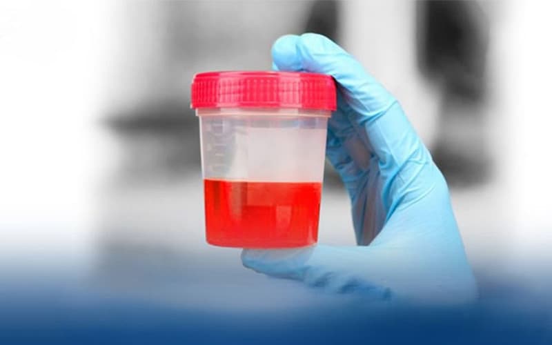 khi nào cần nội soi bàng quang