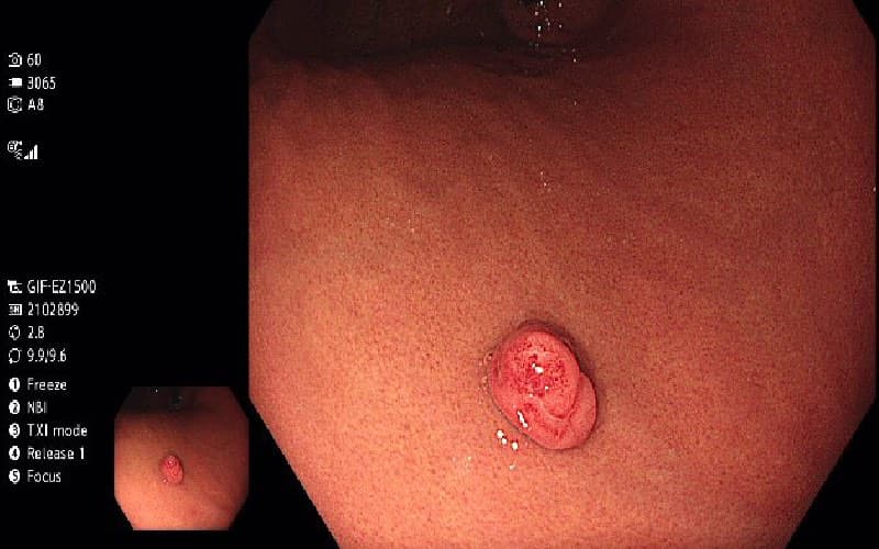 nội soi dạ dày không sinh thiết là gì