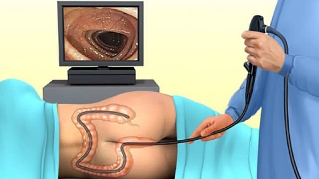 Nội soi đại tràng gây mê mất bao lâu? Có nguy hiểm không?