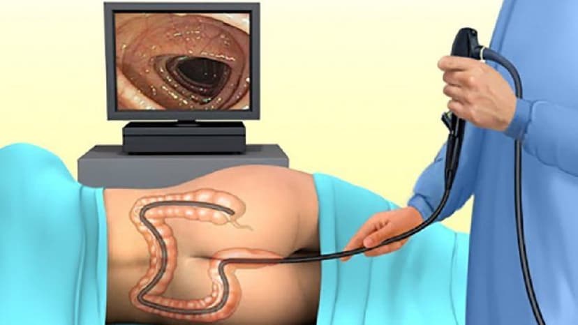 Nội soi đại tràng gây mê mất bao lâu? Có nguy hiểm không?