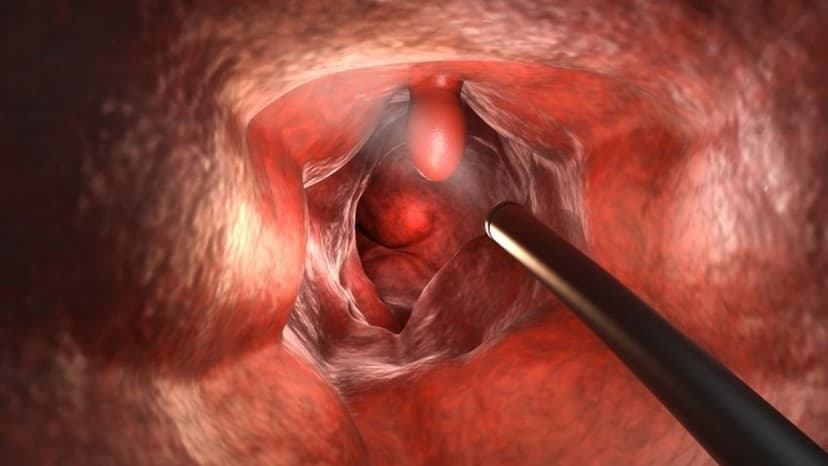 Nội soi đại tràng không sinh thiết là gì?