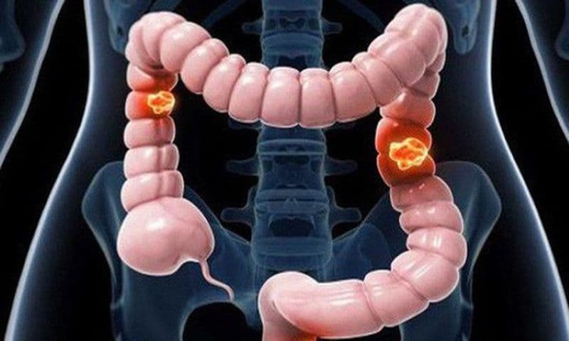 nội soi đại tràng không sinh thiết