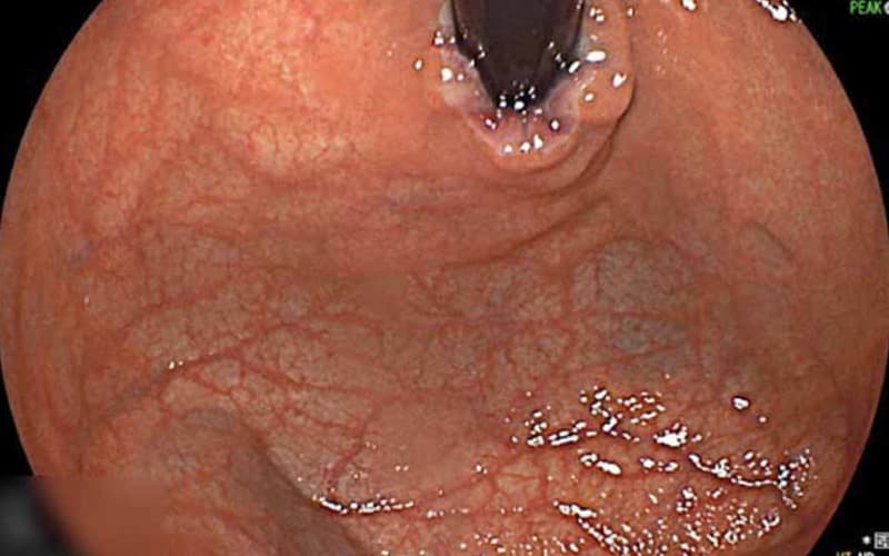 nội soi dạ dày không sinh thiết là gì