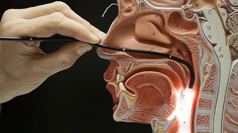 nội soi thực quản có cần gây mê không