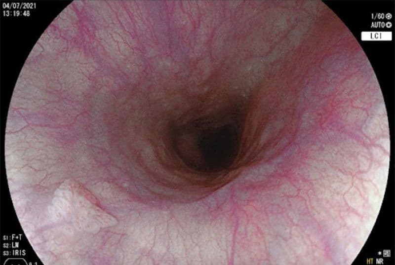 hình ảnh nội soi thực quản bình thường