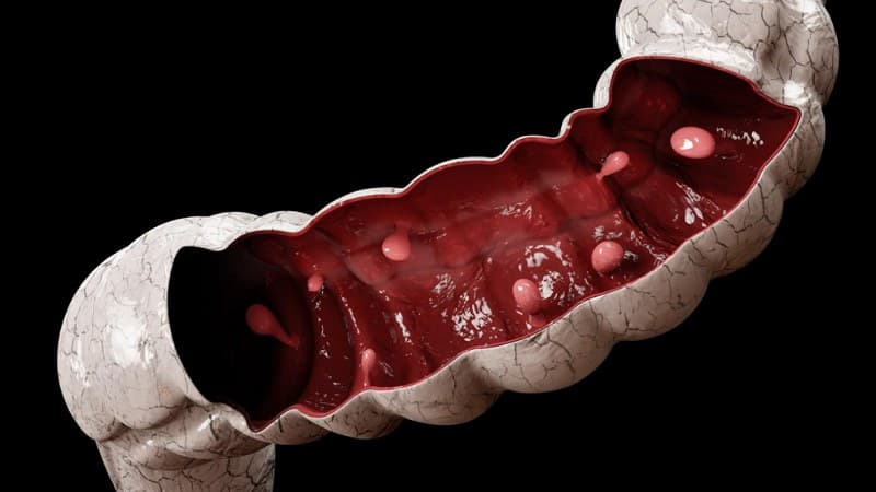 điều trị polyp đại tràng ác tính