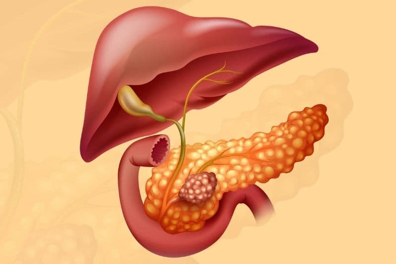 cách điều trị bệnh ung thư đường mật