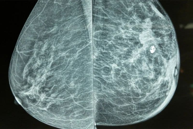 ung thư vú phát hiện sớm có chữa khỏi không