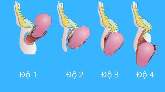 Chỉ định phẫu thuật sa bàng quang