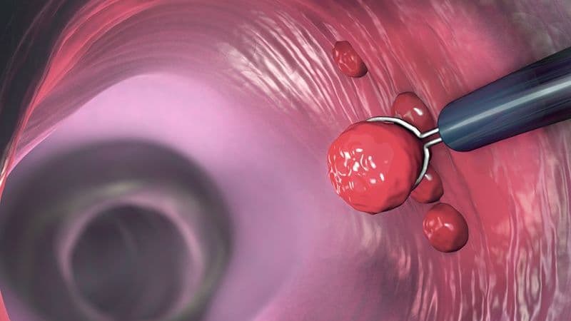 polyp đại tràng tái phát