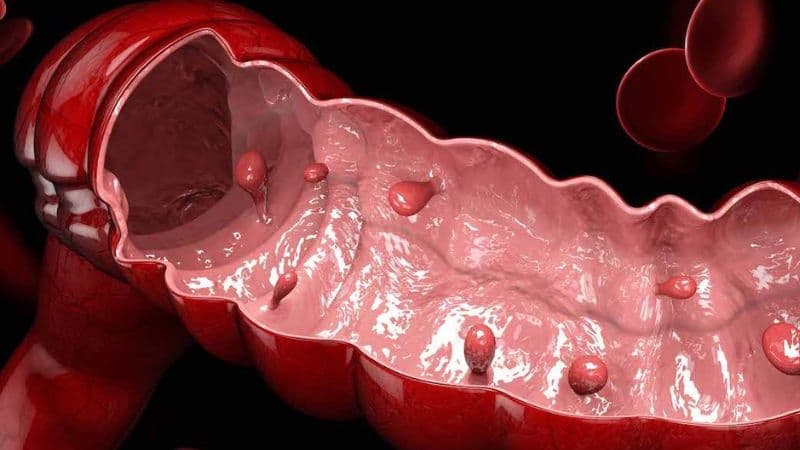 polyp đại tràng có nguy hiểm không