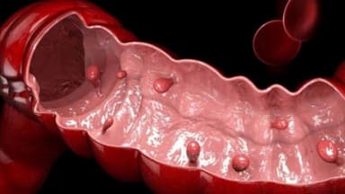 Bị polyp đại tràng có gây táo bón không?