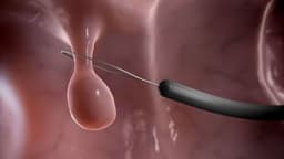 Polyp đại tràng có nguy hiểm không?