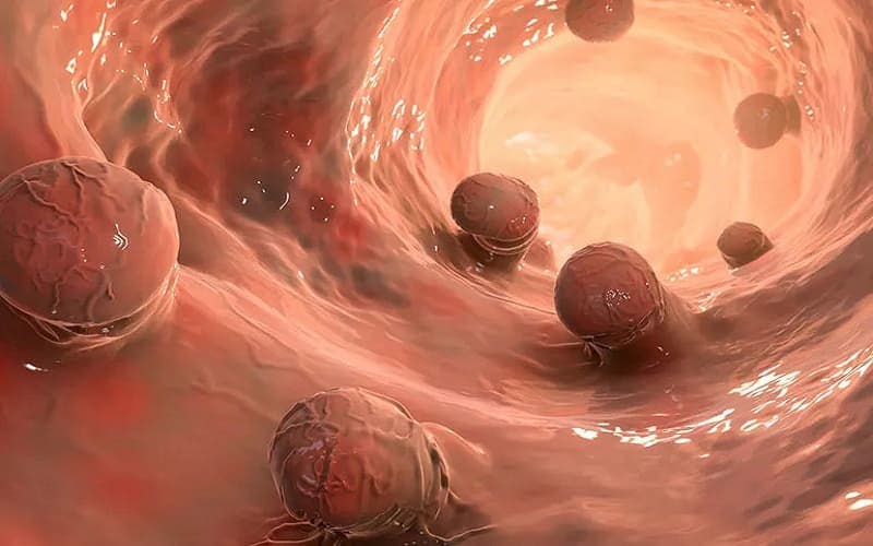 polyp đại tràng sigma không cuống