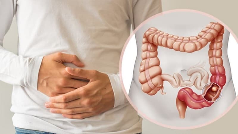 triệu chứng của polyp đại tràng lành tính