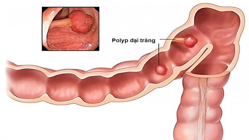 triệu chứng của polyp đại tràng lành tính
