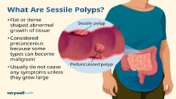 Polyp đại tràng sigma không cuống là gì?