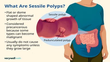 Polyp đại tràng sigma không cuống là gì?