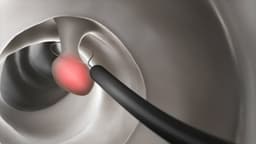 Làm gì khi bị polyp đại tràng tái phát?