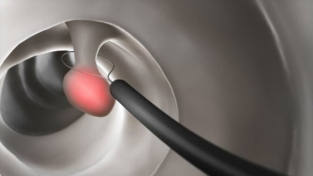 Làm gì khi bị polyp đại tràng tái phát?