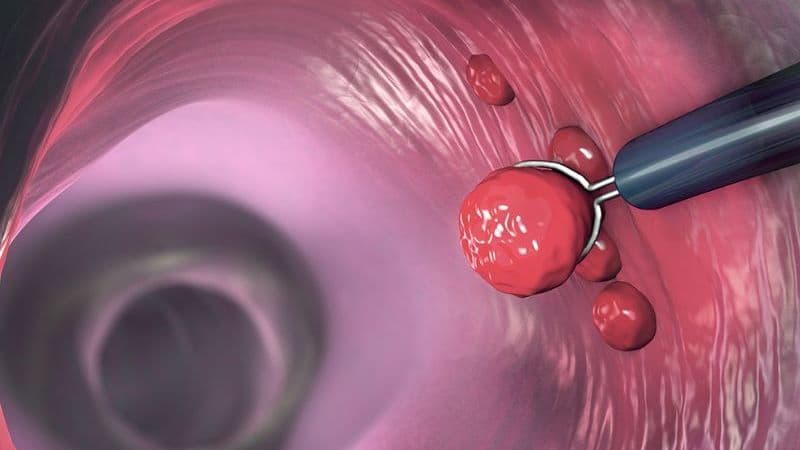 các loại polyp đại tràng