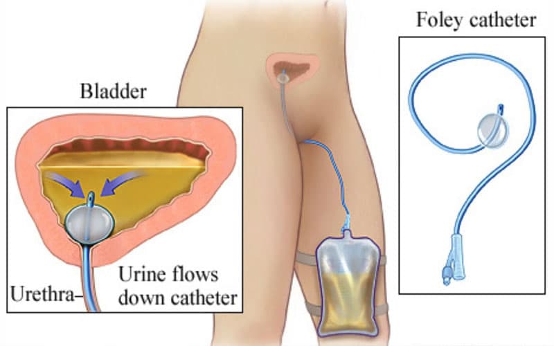 đặt sonde bàng quang