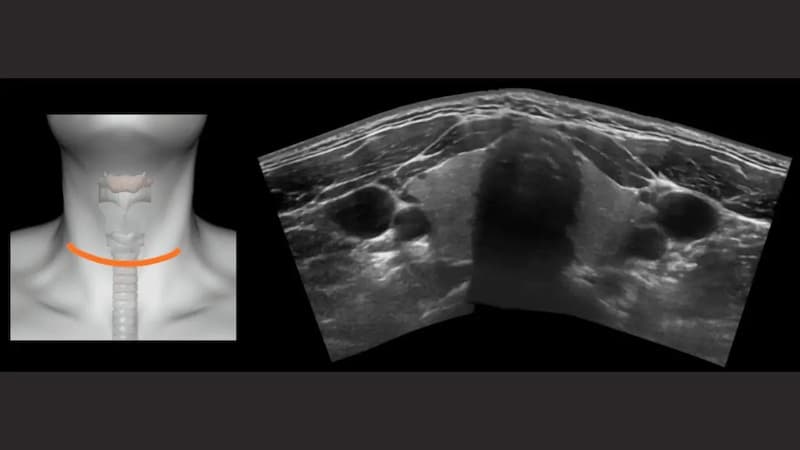 quy trình siêu âm hạch vùng cổ