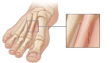 Bị rạn xương ăn gì mau lành?