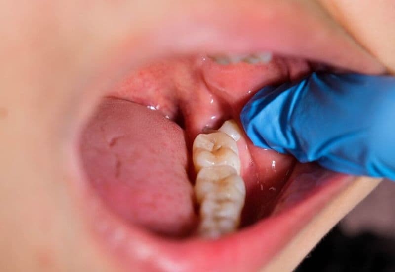 răng bị xô lệch do răng khôn