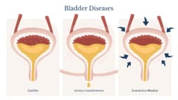 Rối loạn bàng quang có nguy hiểm không?