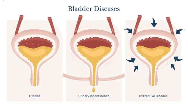 Rối loạn bàng quang có nguy hiểm không?