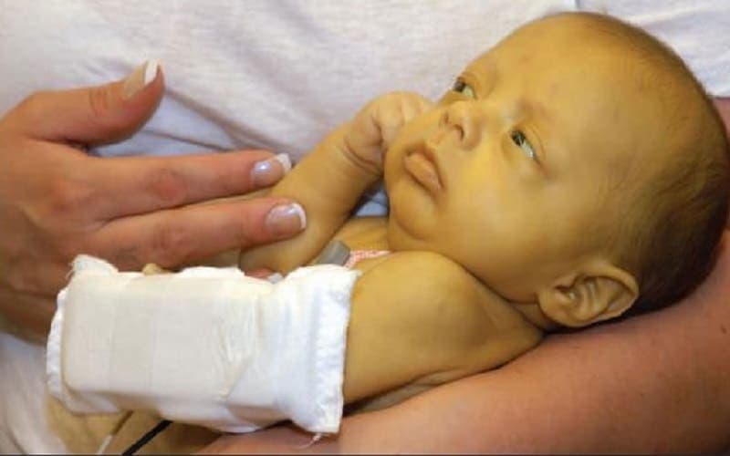 rối loạn chuyển hóa citrin