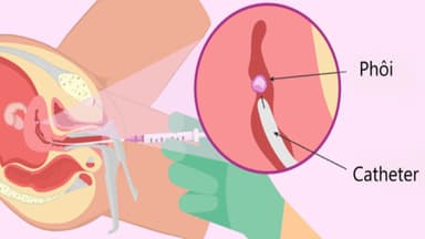 Vì sao bị rối loạn tiêu hóa sau chuyển phôi?