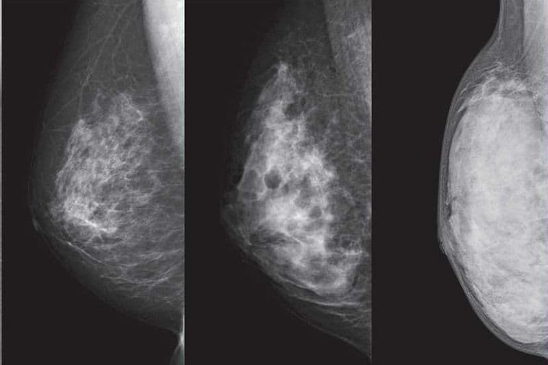 siêu âm có phát hiện ung thư vú không