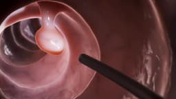 Khi nào cần sinh thiết qua nội soi?