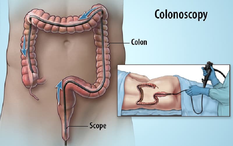 nội soi đại tràng không gây mê có đau không
