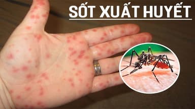 Sốt xuất huyết có bị tiêu chảy không?