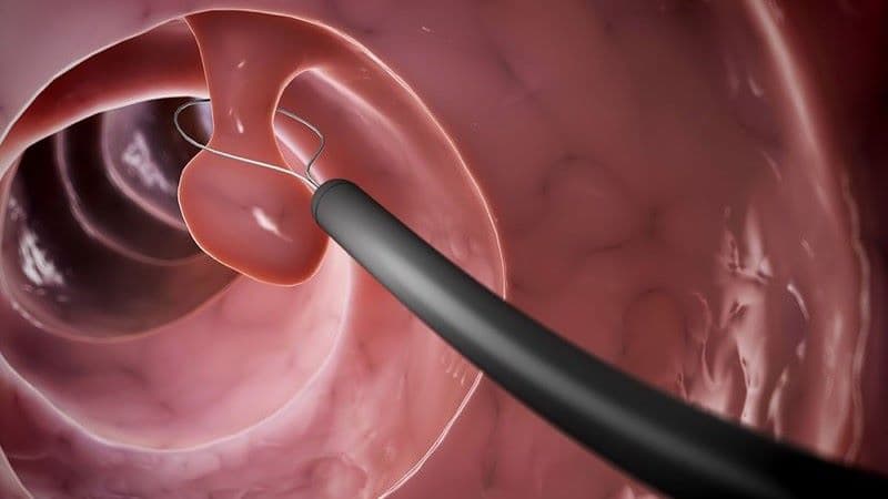 cắt polyp đại tràng xong bị táo bón