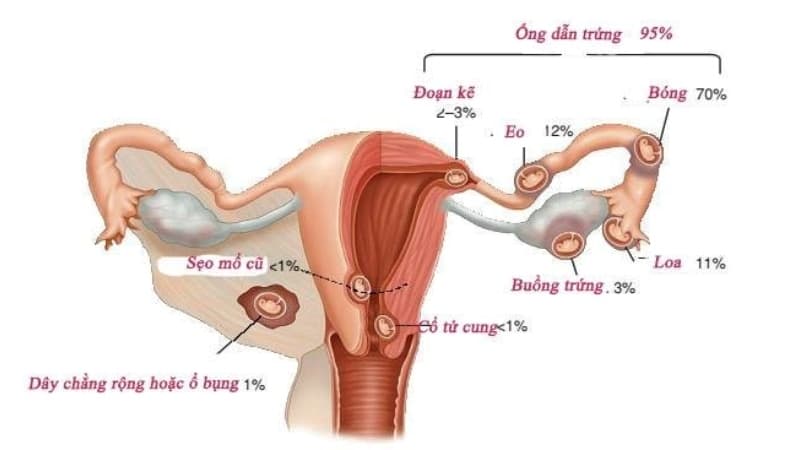 thai ngoài tử cung có bị lần 2 không